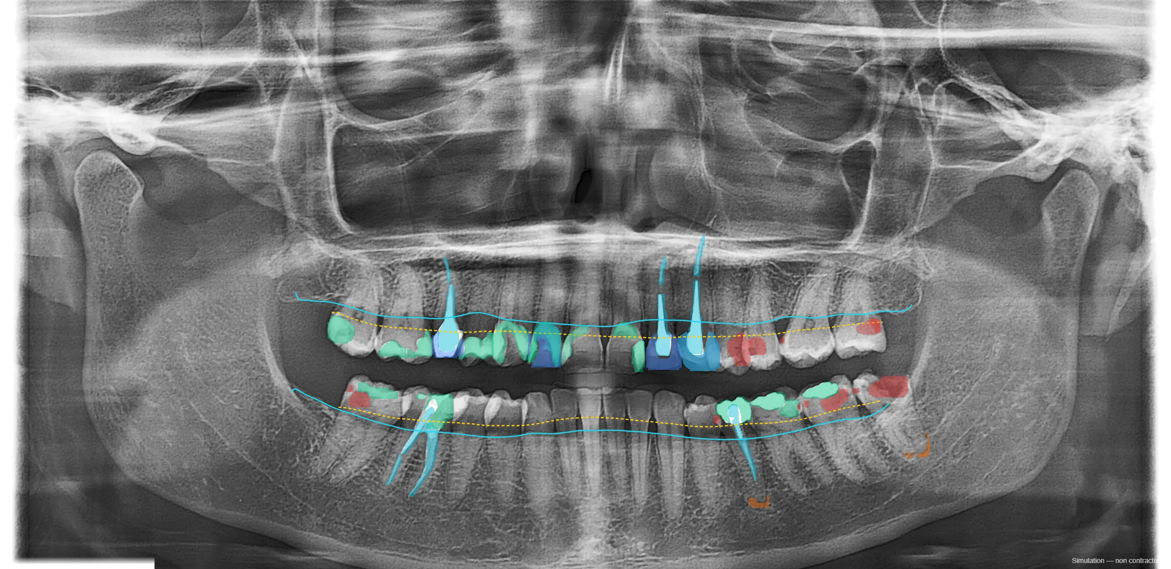 Analyse IA DentiVision avec annotations des pathologies dentaires